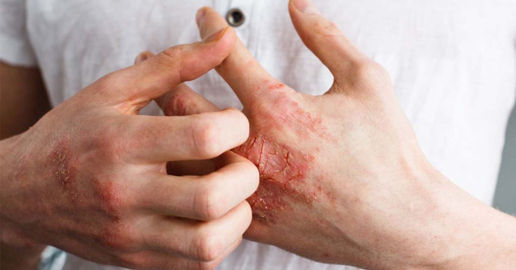 Oral Medication Shows Strong Promise for Moderate to Severe Eczema in