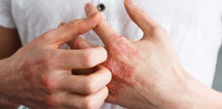 Atopic Dermatitis (Eczema)