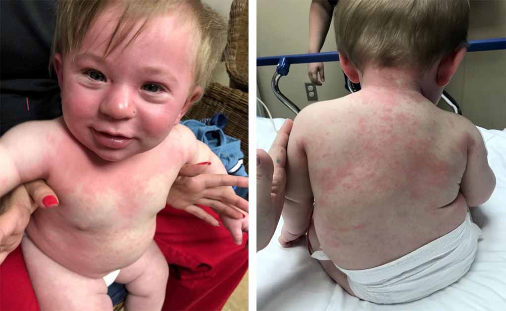 Baby Suffers Anaphylaxis After Feet Dipped In Craft Paint Snacksafely Com