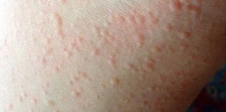 Cold-Induced Urticaria