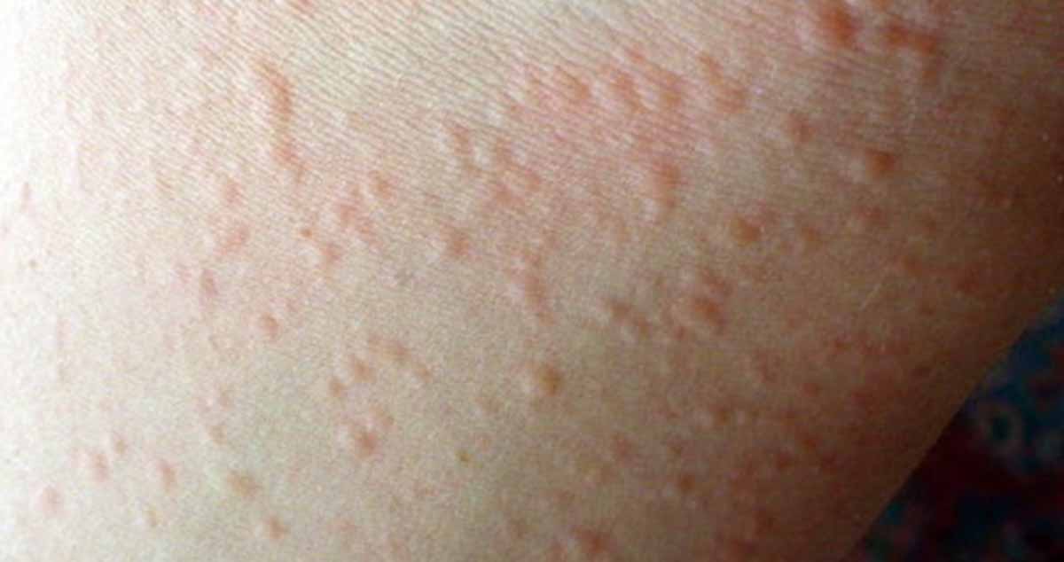 Cold-Induced Urticaria