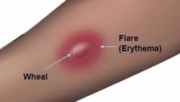 Flare Size in Skin Prick Testing for Children May Predict Oral Food  Challenge Outcomes