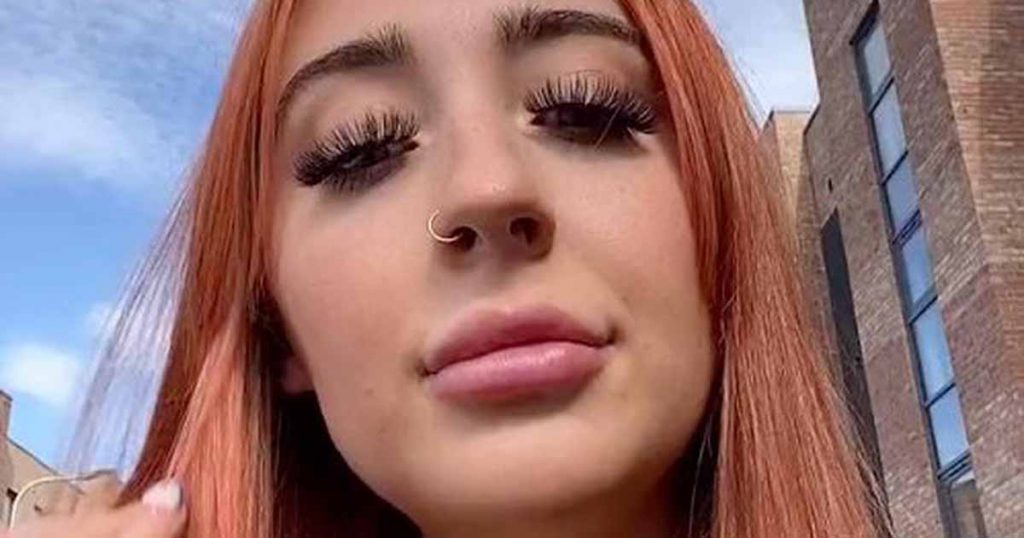 Woman Suffers Anaphylaxis from Lip Fillers, Films Ordeal on TikTok