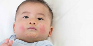 Baby with Eczema