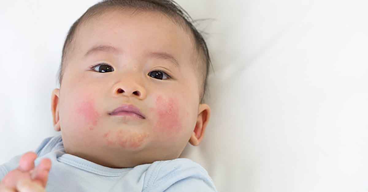 Baby with Eczema