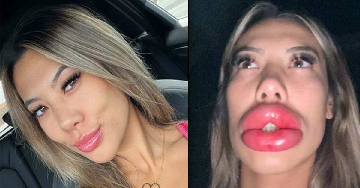 allergic reaction on lips