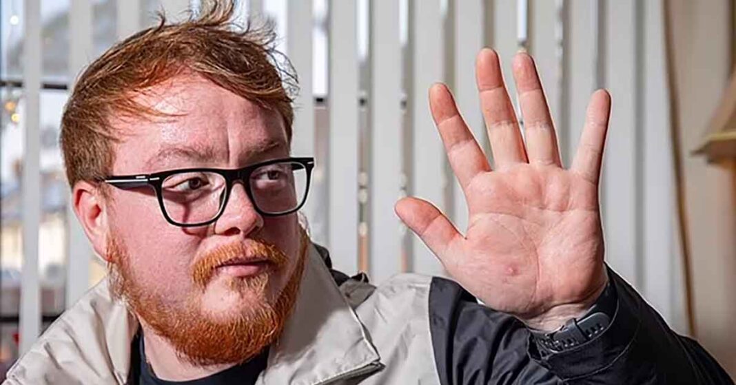 Nathan Halliday Showing Hand with Hamster Bite