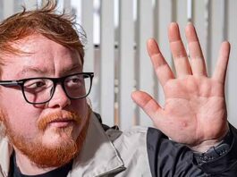 Nathan Halliday Showing Hand with Hamster Bite