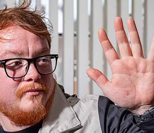 Nathan Halliday Showing Hand with Hamster Bite