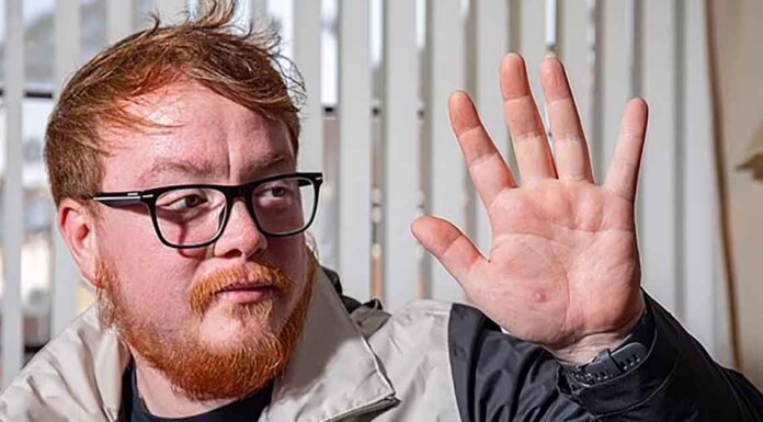 Nathan Halliday Showing Hand with Hamster Bite