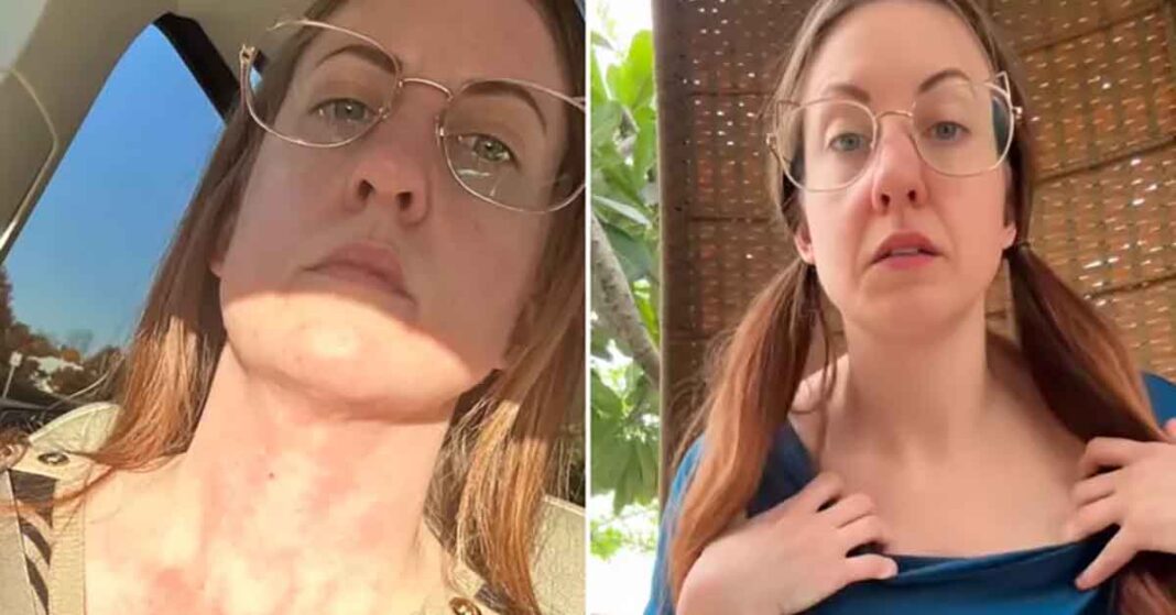 Bee showing a rash after eating a food in the US and showing no rash after eating the same food in Europe.