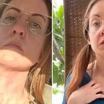 Bee showing a rash after eating a food in the US and showing no rash after eating the same food in Europe.