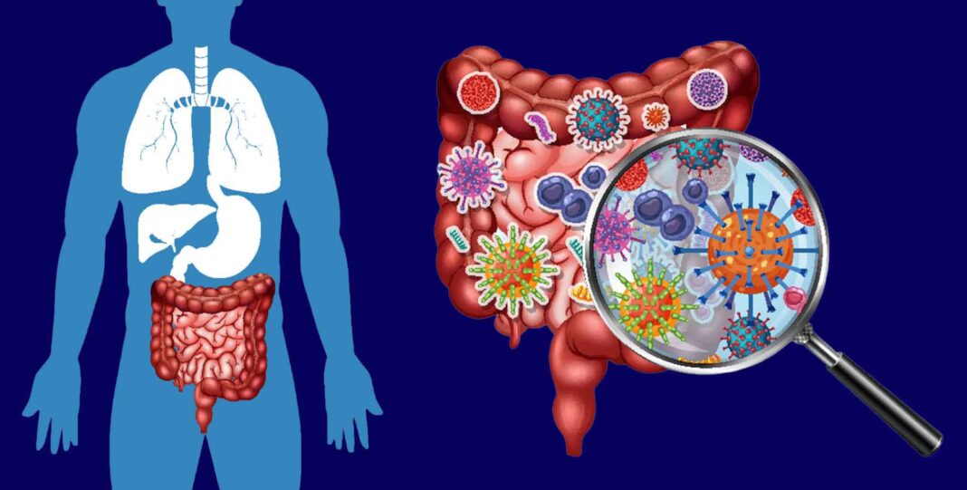 Small Intestine Bacterial Overgrowth (SIBO)