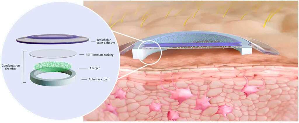 FDA Agreement Clears Regulatory Path for Viaskin Peanut Patch 1 Viaskin Patch Detail