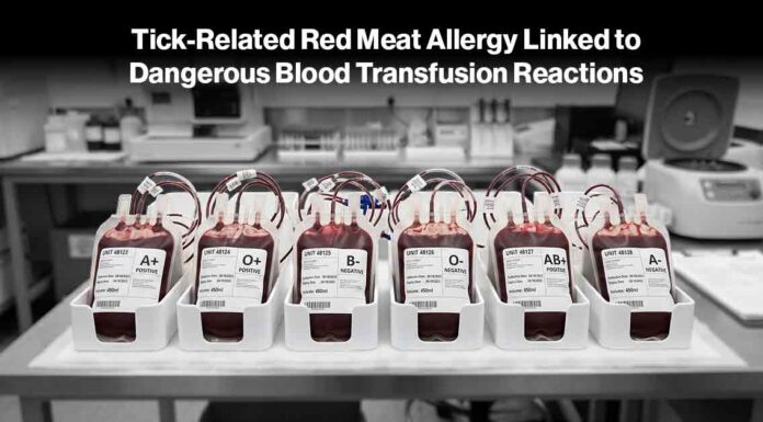 Tick-Related Red Meat Allergy Linked to Dangerous Blood Transfusion Reactions AGS Blood Transfusion Danger - AI-Generated
